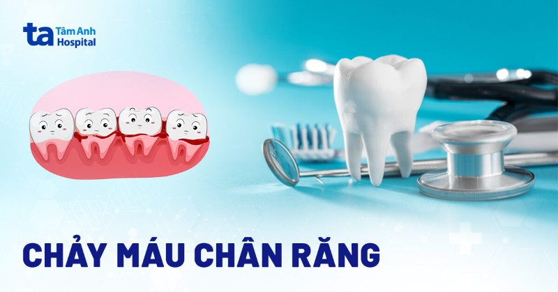 Chảy máu chân răng: Nguyên nhân, cách chữa trị và phòng ngừa