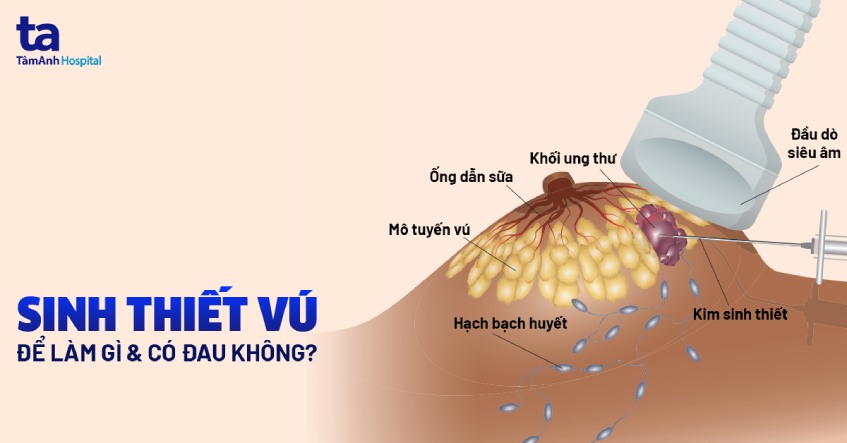 Sinh thiết vú: Quy trình ra sao, có đau không, bao lâu có kết quả?