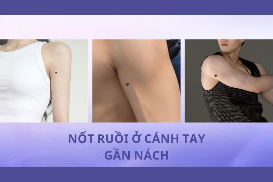 Nốt ruồi ở nách mang ý nghĩa tốt hay xấu? Có nên xóa không?