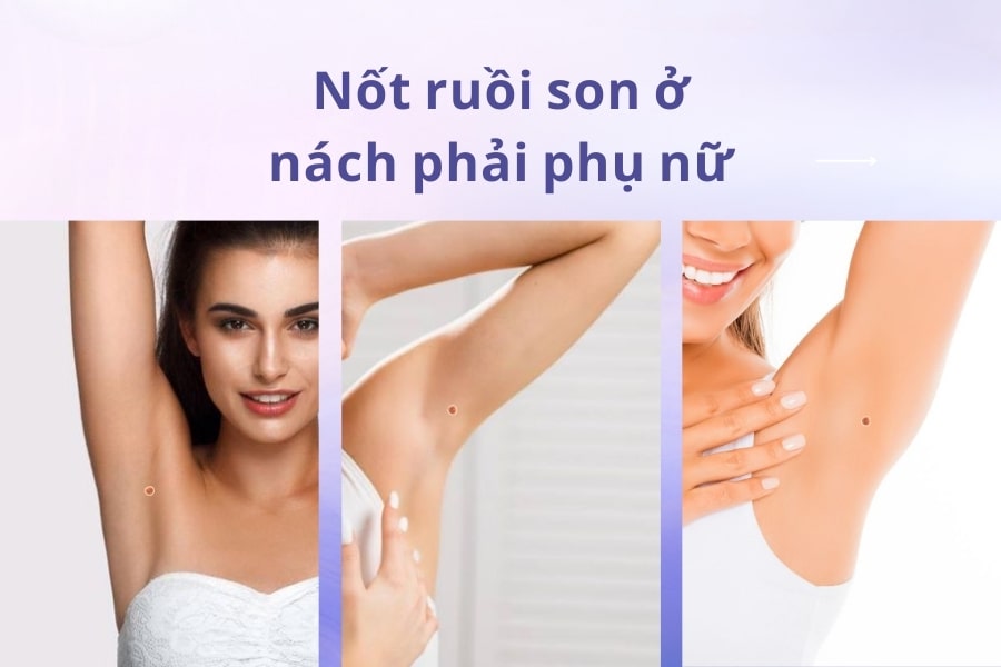 Nốt ruồi ở nách mang ý nghĩa tốt hay xấu? Có nên xóa không?