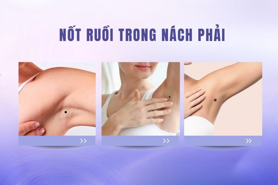 Nốt ruồi ở nách mang ý nghĩa tốt hay xấu? Có nên xóa không?