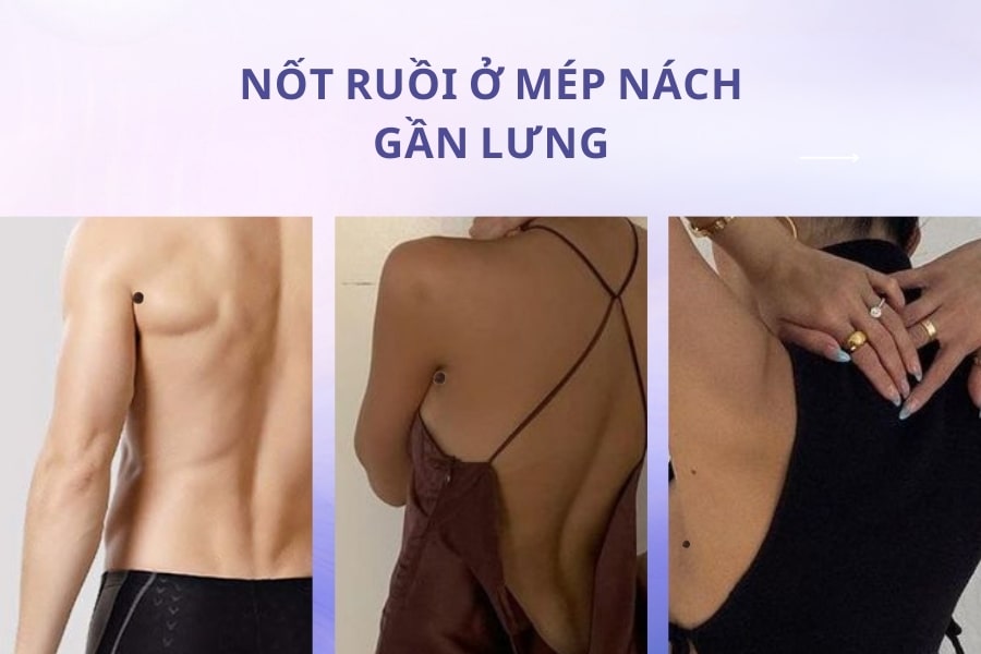 Nốt ruồi ở nách mang ý nghĩa tốt hay xấu? Có nên xóa không?