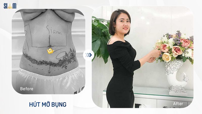 Bảng giá chi phí hút mỡ toàn thân chi tiết - Cập nhật 2024