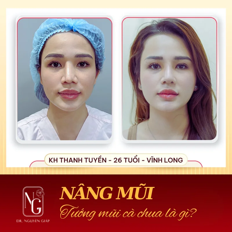 Tướng Mũi Cà Chua Là Gì? Ý Nghĩa Tướng Số Và Cách Cải Thiện