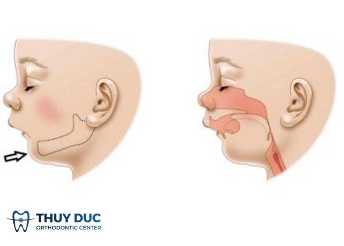 Nhận biết CẰM LẸM, nguyên nhân và cách ‘xóa sổ’ cằm lẹm