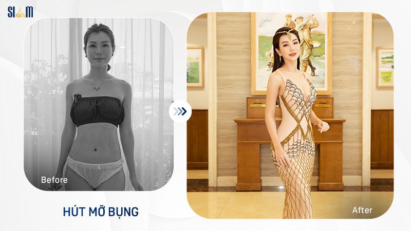 Bảng giá chi phí hút mỡ toàn thân chi tiết - Cập nhật 2024