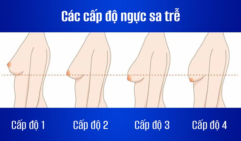 [Mới nhất 2023] Nâng ngực giá bao nhiêu tiền: Bảng giá thẩm mỹ vùng ngực tốt nhất hiện nay 