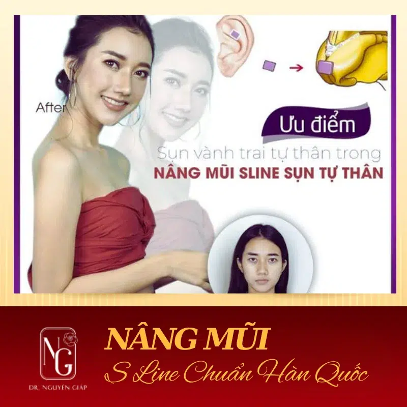 Nâng mũi S-line Hàn Quốc