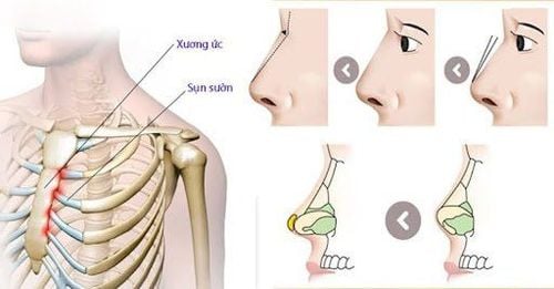 Nâng mũi sụn sườn như thế nào? Nên hay không làm nâng mũi sụn sườn