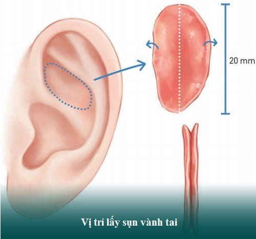 Nâng mũi bọc sụn tai có an toàn không