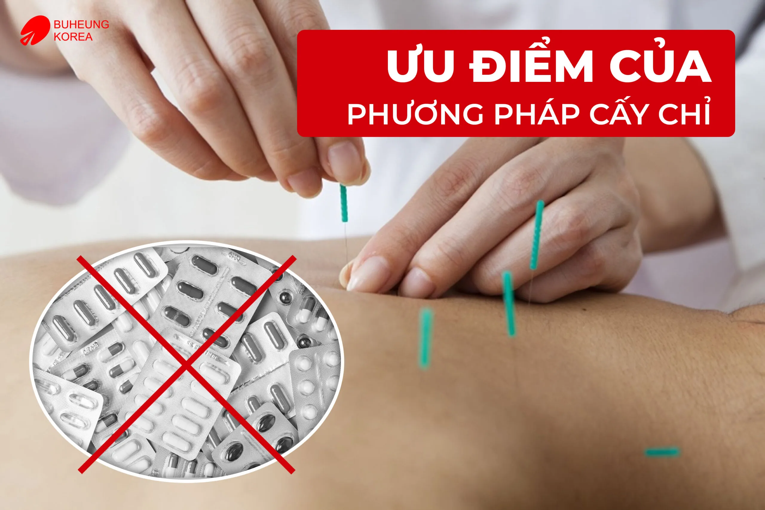 Công Dụng Và Tác Dụng Phụ Của Phương Pháp Cấy Chỉ