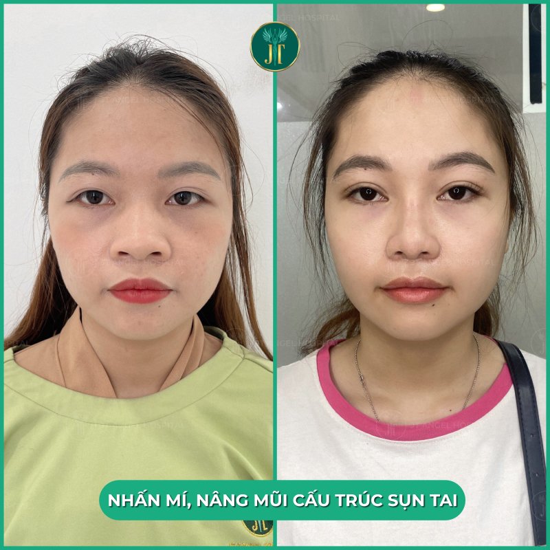 Thu nhỏ đầu mũi: Giải pháp tối ưu hài hòa gương mặt dành cho những người đầu mũi to