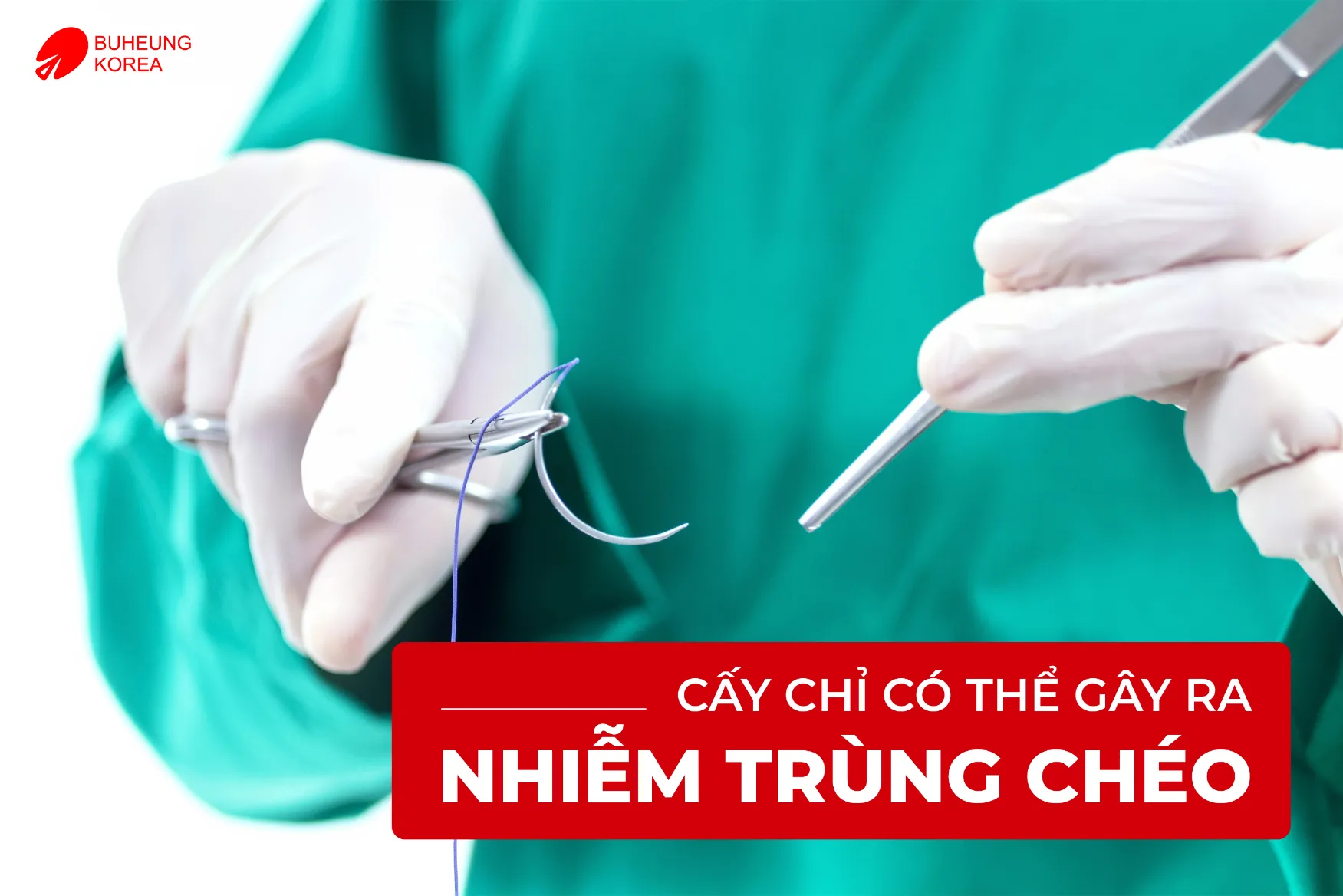 Công Dụng Và Tác Dụng Phụ Của Phương Pháp Cấy Chỉ