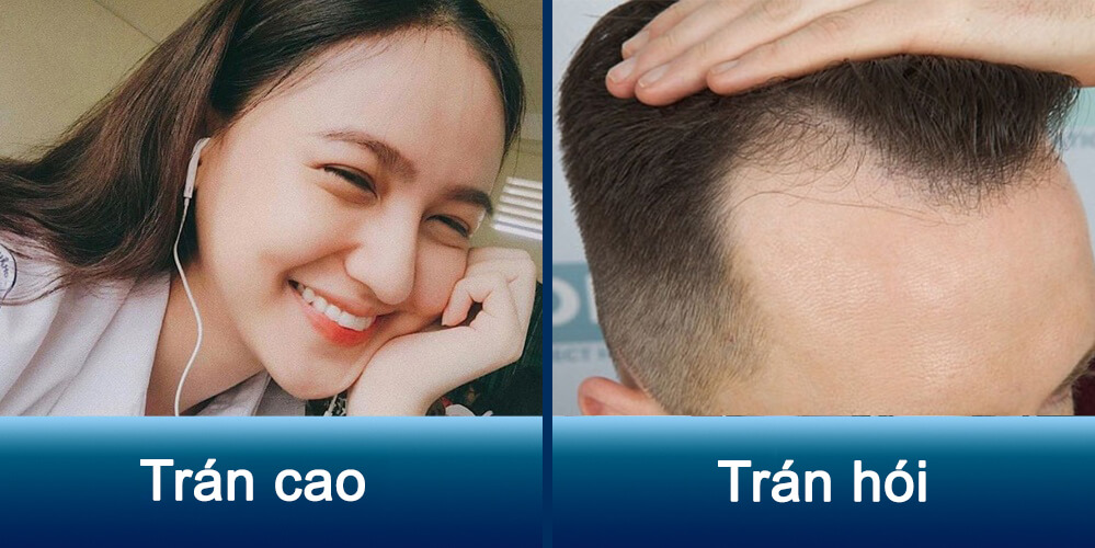 Trán cao là gì? Vận mệnh của người trán cao như nào?