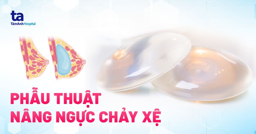 Phẫu thuật nâng ngực chảy xệ: Chỉ định và quy trình