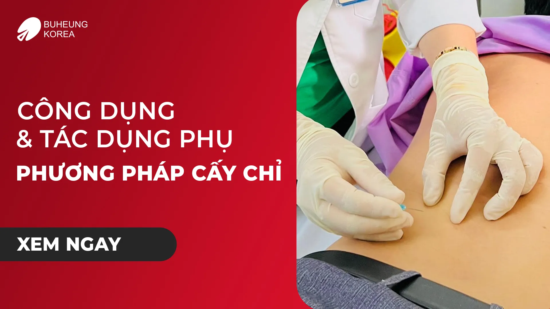 Công Dụng Và Tác Dụng Phụ Của Phương Pháp Cấy Chỉ