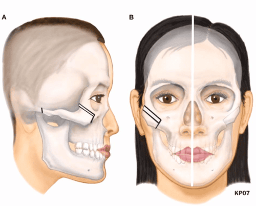 Hạ gò má: Những điều cần biết