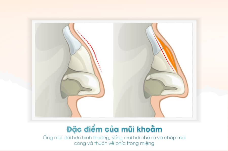 Mũi khoằm là gì? Có nên thay đổi dáng mũi hay không?