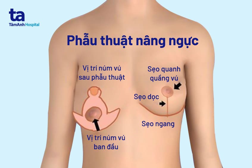 Phẫu thuật nâng ngực chảy xệ: Chỉ định và quy trình