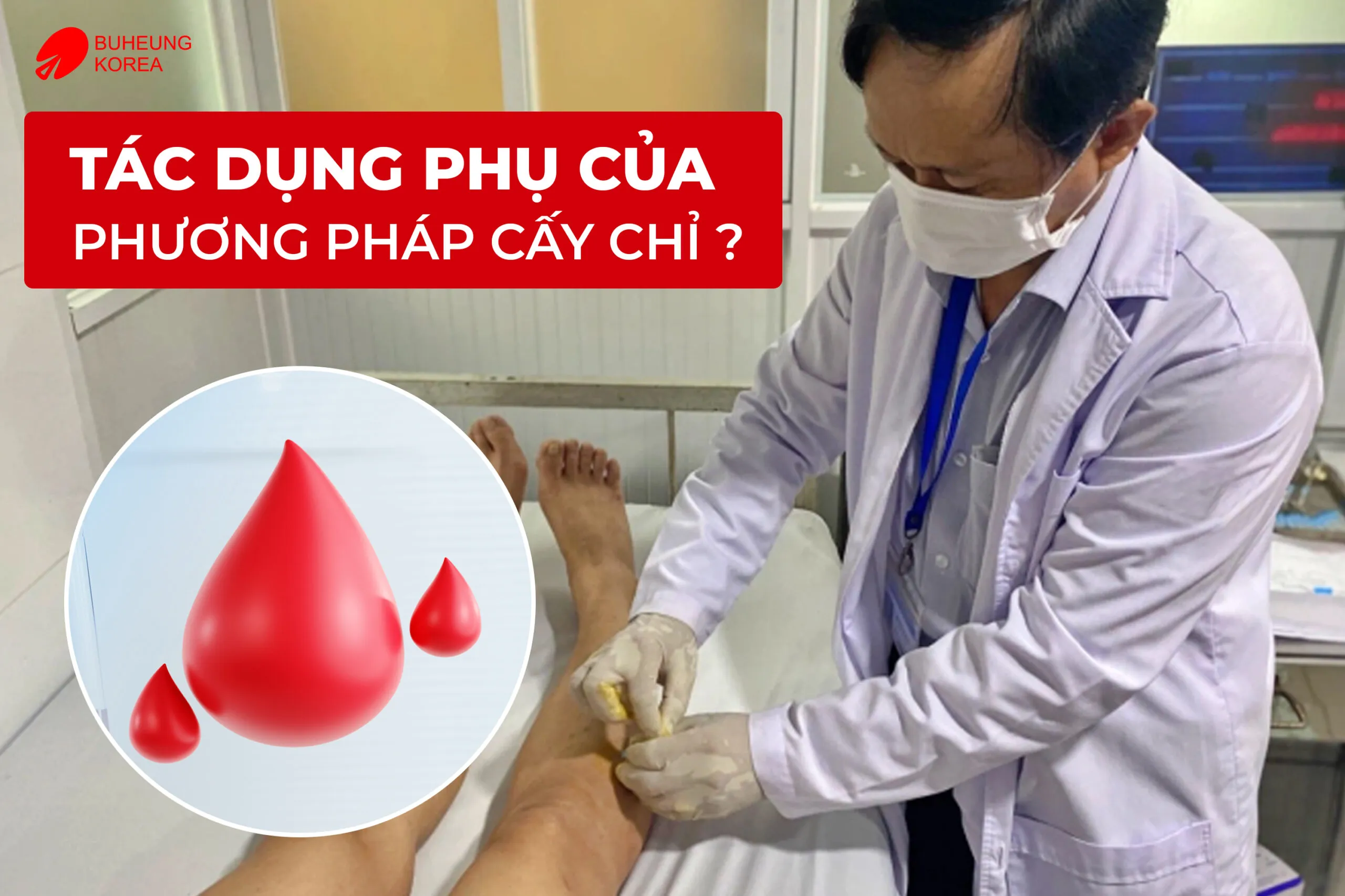 Công Dụng Và Tác Dụng Phụ Của Phương Pháp Cấy Chỉ