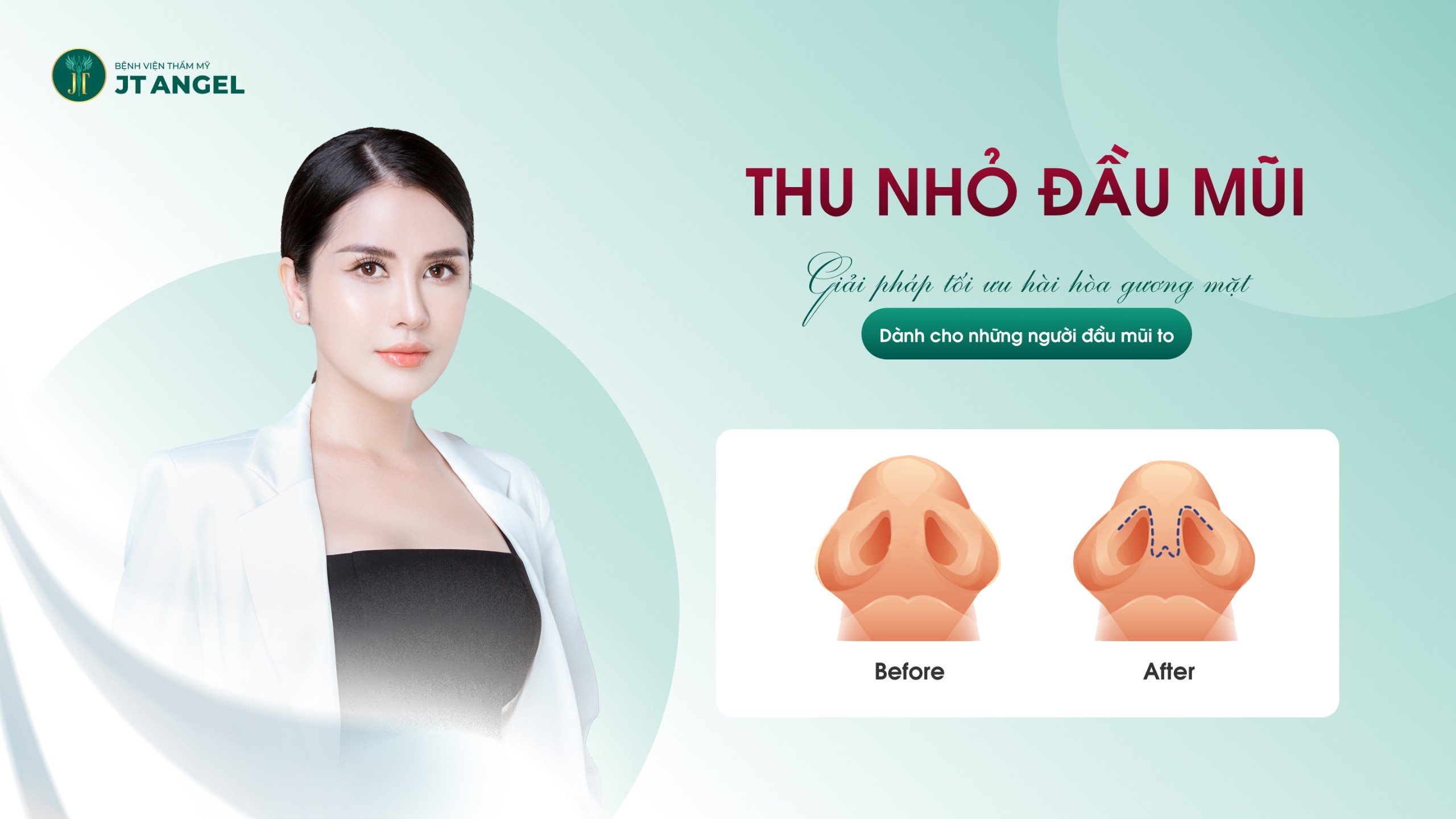 Thu nhỏ đầu mũi: Giải pháp tối ưu hài hòa gương mặt dành cho những người đầu mũi to