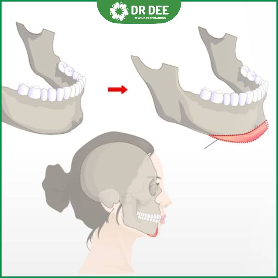 4 cách làm cằm dài ra đơn giản nhất dành cho cả nam và nữ