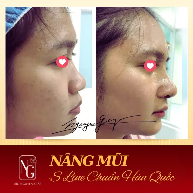 Nâng mũi S-line Hàn Quốc