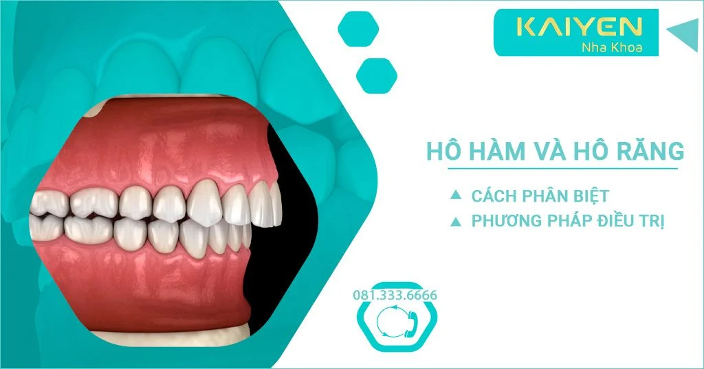 Hô hàm và hô răng: Cách phân biệt và phương pháp điều trị