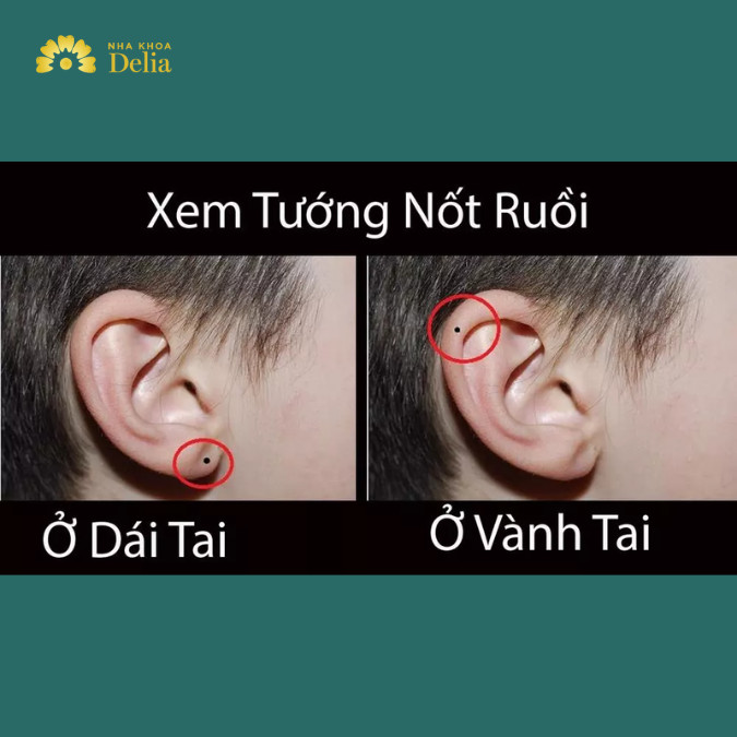 Giải mã 7 nốt ruồi ở tai: vành tai, trong lỗ tai, trước sau tai nam nữ