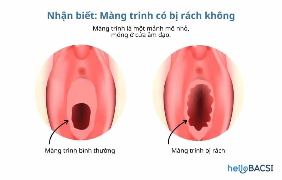 Cách dễ nhận biết màng trinh còn hay rách