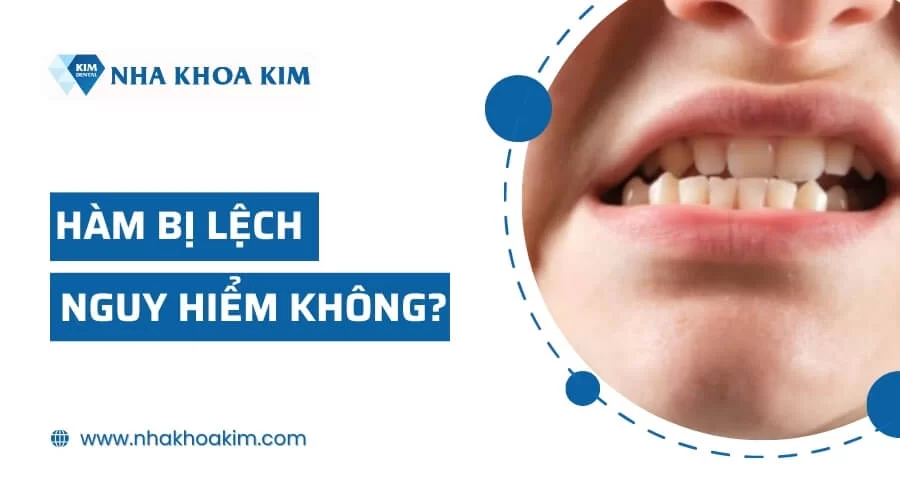 Hàm lệch là gì? Điều trị bằng cách nào cho gương mặt đẹp cân đối?