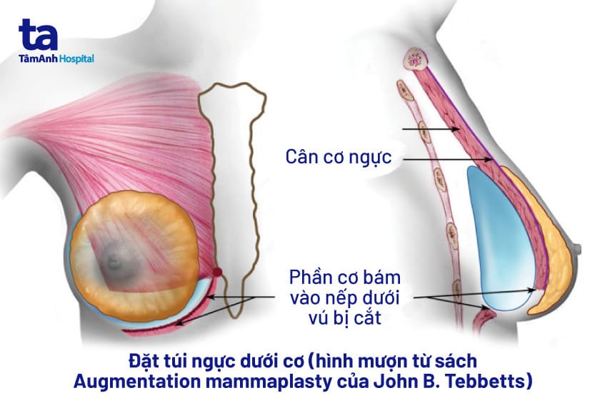 Đặt túi ngực: Chỉ định, quy trình và lưu ý quan trọng