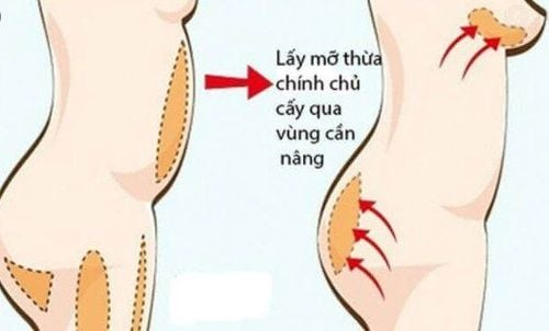 Các phương pháp nâng mông phổ biến hiện nay