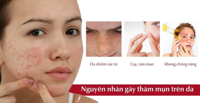 13 Cách Trị Thâm Mụn Tại Nhà Hiệu Quả Và Nhanh Chóng Nhất