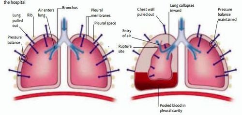 Sơ cứu vết thương ngực hở tại hiện trường