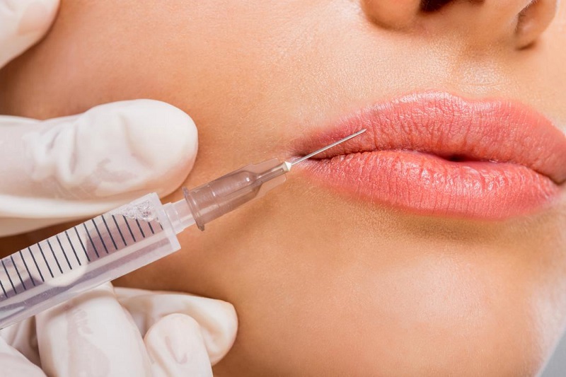 Filler là gì? Những lưu ý khi muốn làm đẹp bằng filler