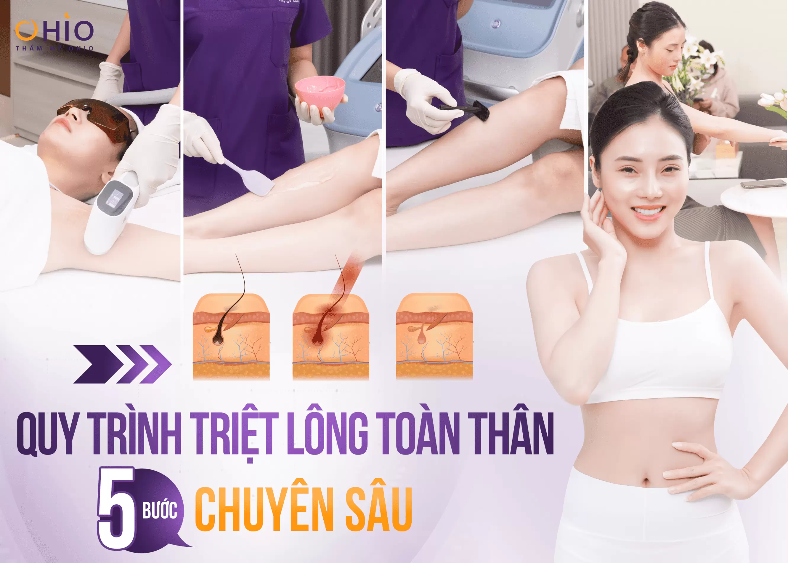 Triệt lông toàn thân 2024 vĩnh viễn và những điều cần lưu ý