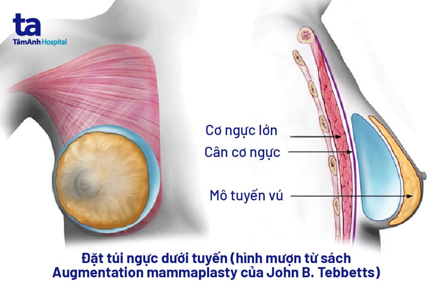 Đặt túi ngực: Chỉ định, quy trình và lưu ý quan trọng