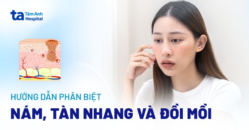 Hướng dẫn cách phân biệt nám và tàn nhang, đồi mồi chuẩn xác